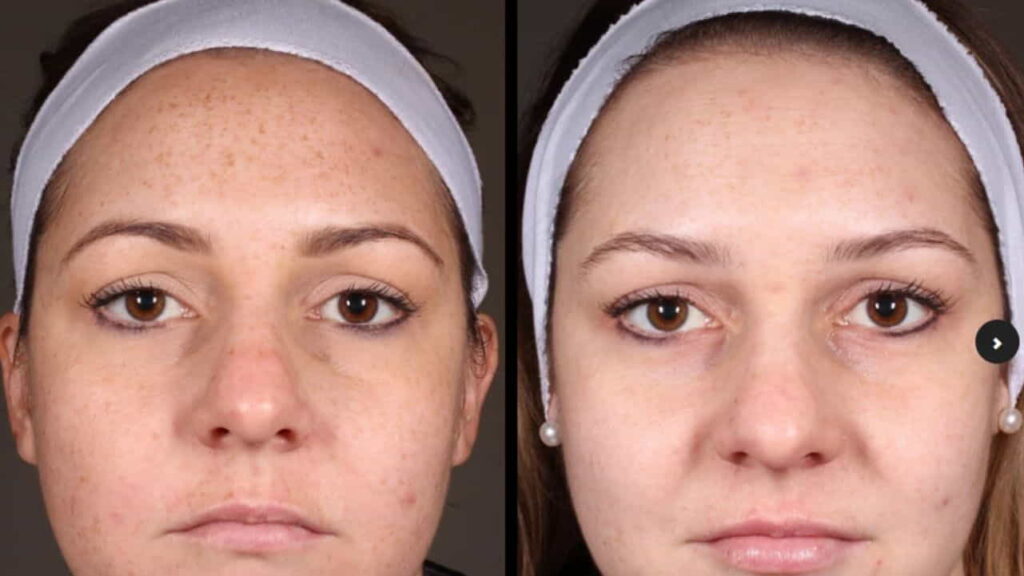 chemical peels in tasmania, dermatology institute of victoria – light skin peels